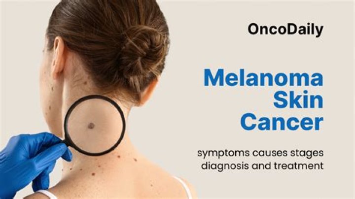 About Her Melanoma Diagnosis – Hollywood Life