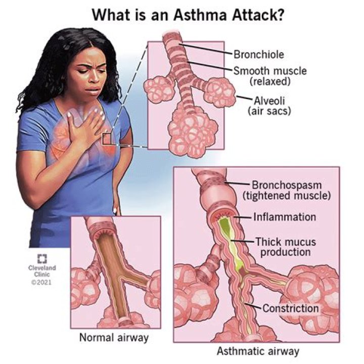 Laurel Griggs, 13, Died From Asthma Attack: How Her Death Could Have Been Prevented – Doctor Explains